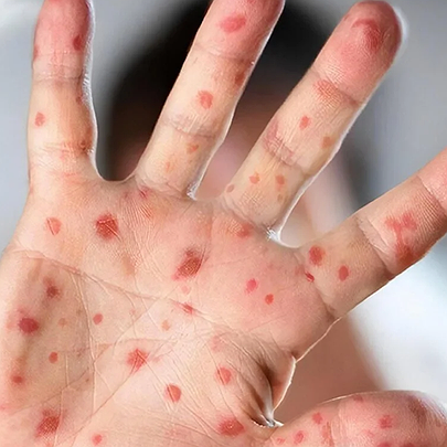 На Київщині зафіксовано спалах хвороби Коксакі: що це таке - 412x412